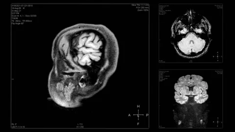 Head / Braim MRI scan from different angles Stock Footage 155460466