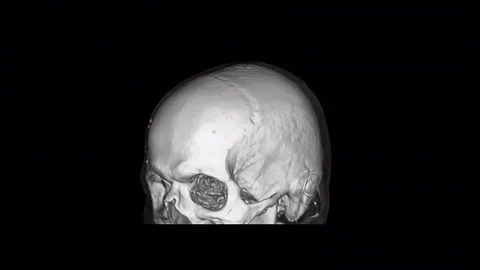 Head Ct Scan 3d Stock Footage