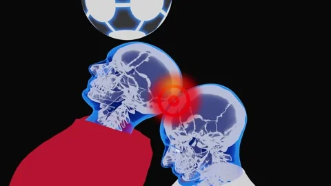Head-to-Head Collision Causing Concussion – Sports Injury Visualization Видео 342089076