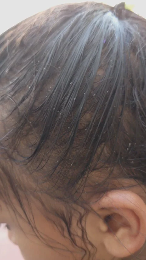 Head Lice Eggs Or Nits In Child Hair: 4k Vertical: Sibi, Pakistan. 29 June 2026 Video stock 337963915