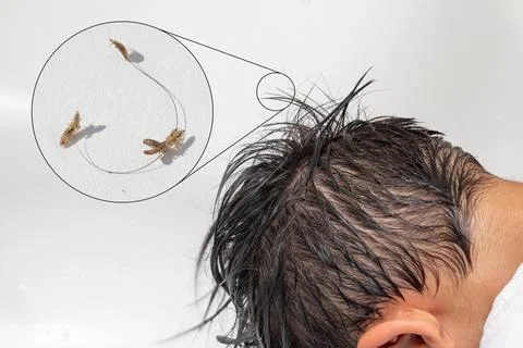 Head lice infestation problem on child's scalp with magnified parasites Photos