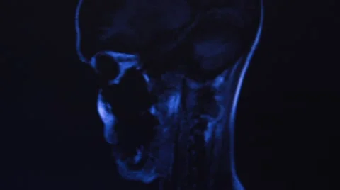 Head MRI of a 34 years old woman Stock Footage 43965020