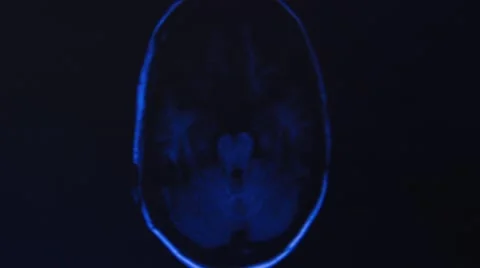 Head MRI of a 34 years old woman Stock Footage 43965204