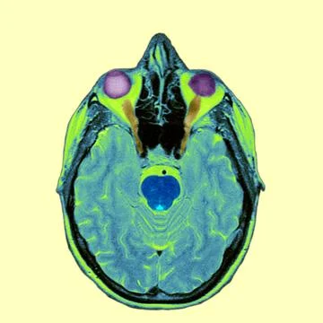  Head, mri Cross-section. 1. Eyeballs 2.Optic nerves. 3.Pons 4.Forth ventr... Stock Photos