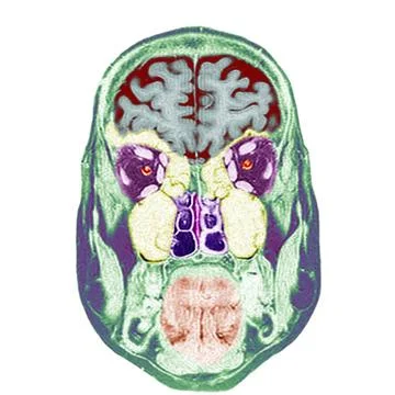  Head, mri Frontal section. 1.Brain. 2.Eyeballs. 3.Optic nerves. 4.Oculo-m... Stock Photos