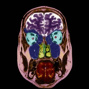  Head, mri Frontal section. 1.Brain. 2.Eyeballs. 3.Optic nerves. 4.Oculo-m... Stock Photos