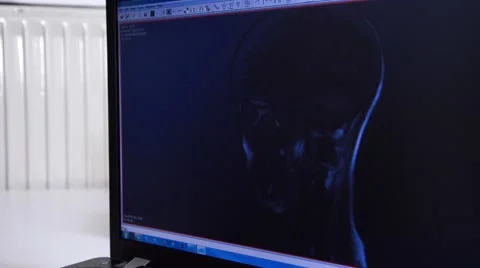 Head MRI slide show on a computer Stock Footage 43965390