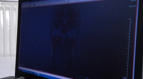 Head MRI slide show on a computer Stock Footage 43965773