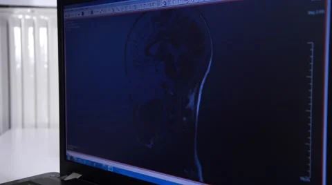 Head MRI slide show on a computer Stock Footage 43965903