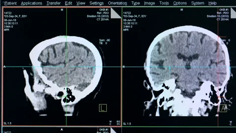A head scan, close up. Screen with head scanning on a special machine at a Stock Footage 92015705