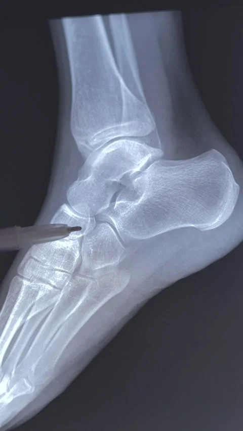 Head of talus Stock Footage 294193087