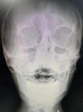A head x-ray Stock Photos