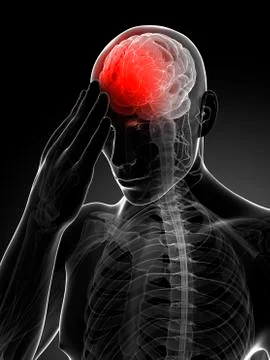 Headache, artwork Stock Illustration
