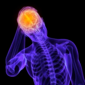 Headache, conceptual artwork Stock Illustration