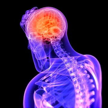 Headache, conceptual artwork Stock Illustration