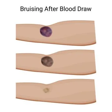 Healing Bruise Progression Post Blood Draw Stock Illustration