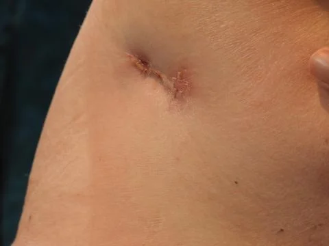 Healing operation wound Stock Photos