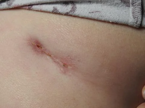 Healing operation wound Stock Photos