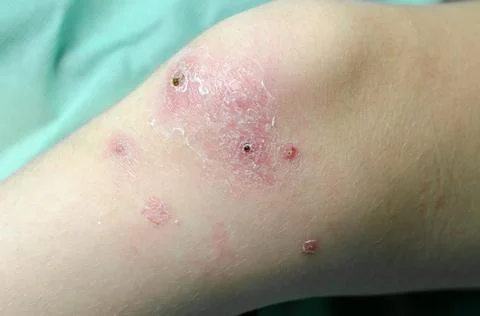 Healing wounds on the knee of a child. Stock Photos