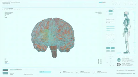 Health diagnostic computer software detects a dangerous growth in the brain Video stock 171662819