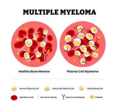 Healthy bone marrow vs plasma cell myeloma specimen blood composition compa.. Stock Illustration