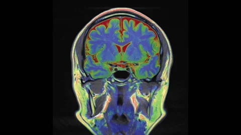 Healthy human brain, coronal MRI scan se... | Stock Video | Pond5