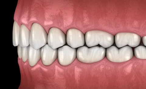 Healthy human teeth with normal occlusion, side view. Medically accurate toot Stock Illustration