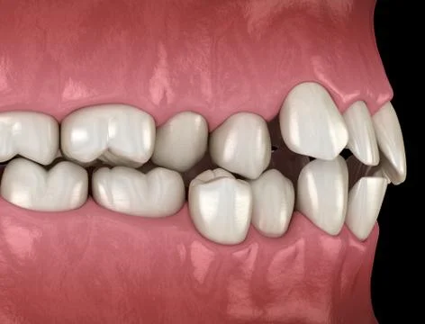 Healthy human teeth with normal occlusion, side view. Medically accurate toot Stock Illustration