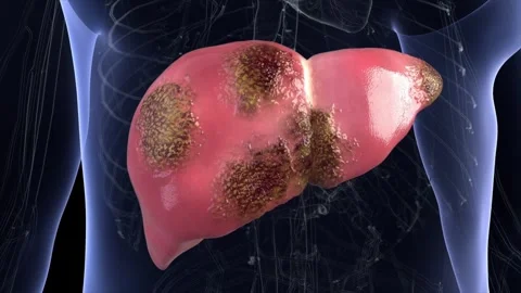 Healthy liver develops lesions from cirrhosis, hepatitis Stockbeeldmateriaal 344102713