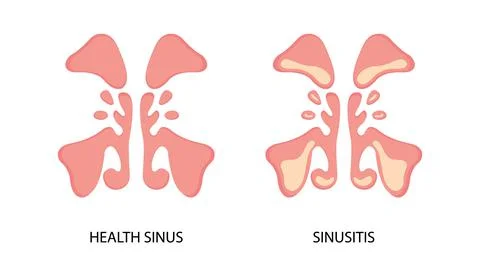 Healthy sinus and sinusitis flat image Stock Illustration