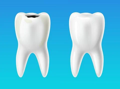 Healthy tooth and decayed tooth. 3D isolated teeth, caries professional Stock Illustration