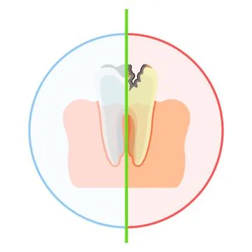 Healthy vs damaged tooth Illustrazione stock