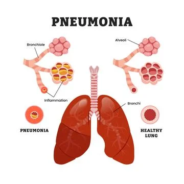 Healthy vs Pneumonia Lung difference, educational medical poster design hea.. Stock Illustration