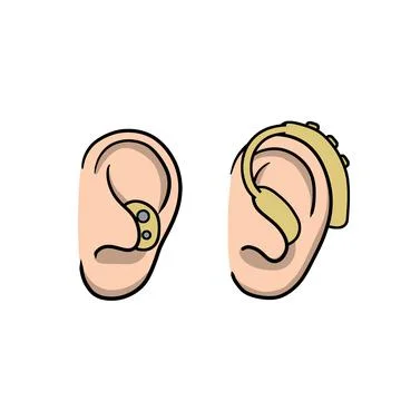 Hearing aid. Audiphone in ear. Hearing problems and disabilities. Stock Illustration