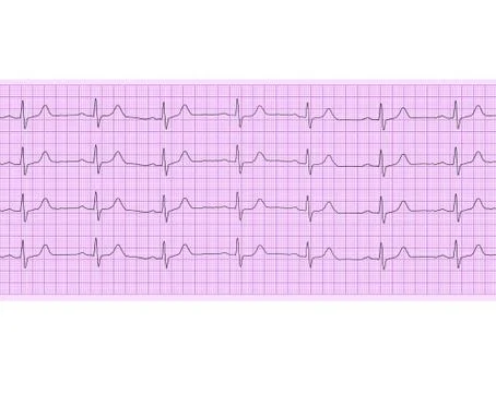Heart analysis, electrocardiogram graph (ECG) Fotos de archivo