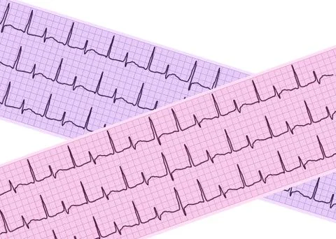 Heart analysis, electrocardiogram graph (ECG) Stock Photos