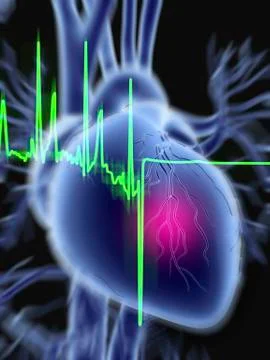 Heart attack and ecg trace Stock Illustration