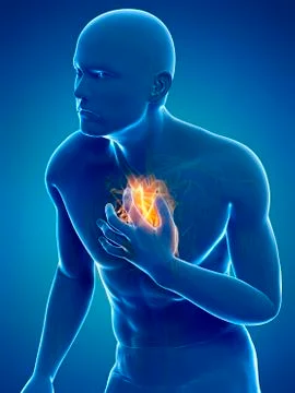 Heart attack, artwork Stock Illustration