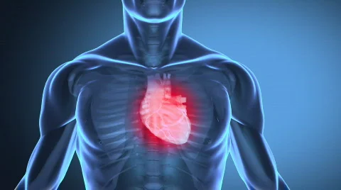 Heart attack concept Stock Footage 697240