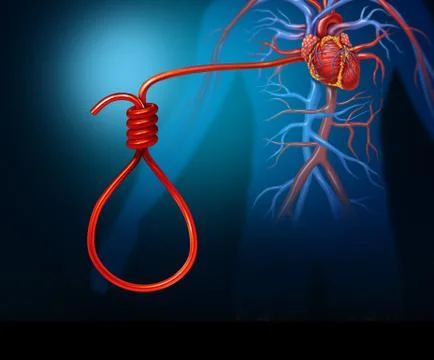 Heart Attack Concept Stock Illustration