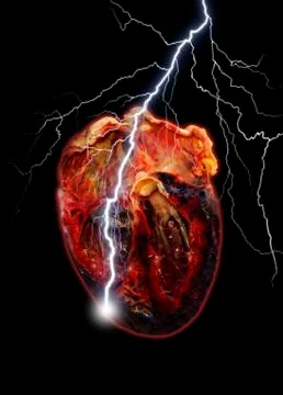Heart attack, conceptual artwork Stock Illustration