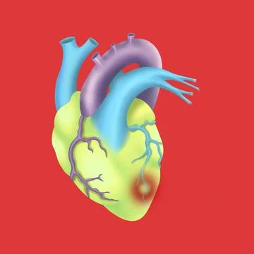 Heart attack, drawing Heart attack, drawing Copyright: xARQUEVAUXx/xBSIPx ... Stock Photos