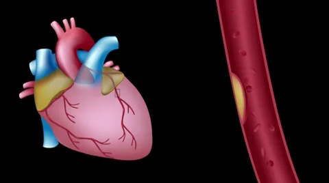 Heart attack, hd animation Stock Footage
