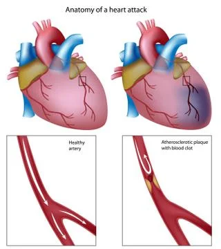 Heart attack Stock Illustration