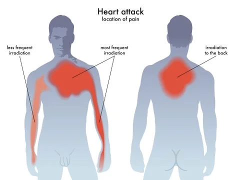 Heart attack pain location Stock Illustration