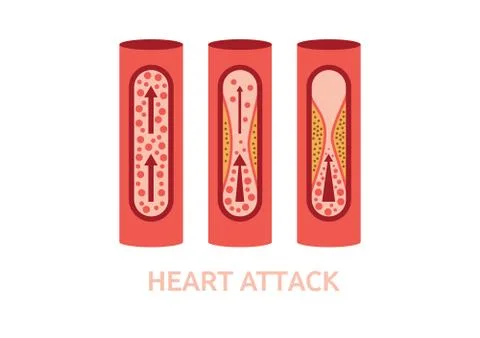 Heart attack symptoms vector Stock Illustration