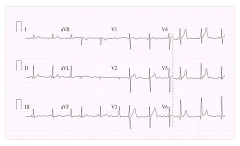 Heart Cardiogram Chart Vector. Illustration Of Wave Form On Checked Ecg Graph Illustrazione stock