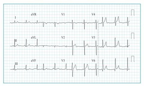 Heart Cardiogram Chart Vector. Illustration Of Wave Form On Checked Ecg Graph Stock Illustration