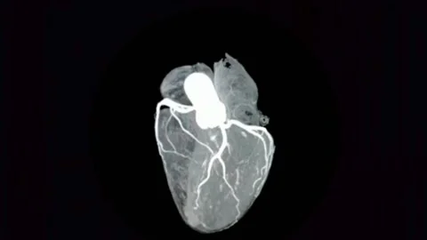 Heart  Failure ct scan in Radiology room Stock Footage 171465066