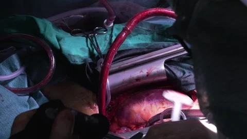 Heart jump-started in an open-heart surgery Video stock 342798792